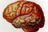 人脑标本。（图片来源：凤凰网健康论坛）