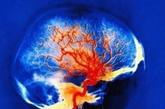 大脑的痛结构 　　脑内与疼痛有关的区域主要有丘脑.脑干网状结构和大脑皮质中的疼痛中枢。这个光子发射计算机化断层显像显示了人在偏头痛的时候的大脑活动，活动比较活跃的是红色和黄色区域，活动较弱的是绿色和蓝色区域。