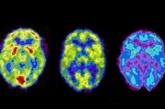 疾病突发时的脑结构 这些PET扫描图显示了大脑在疾病突发前后的变化！ 左边是正常人的脑结构，右边是疾病突发时的脑结构。