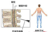 腰麻(孕妇清醒，胸部以下无痛觉)；切开子宫，吸干羊水，取出婴儿；清除婴儿口腔及鼻腔的液体，夹住脐带并剪断，把婴儿交给儿科医生或护士护理，保障其呼吸顺畅，产妇这时是清醒的，可看见她的婴儿及听到其哭声。剖腹产手术现已变得相当普及(在美国占所有分娩个案的20%)，这是由于诊断手段的提高，令医生可准确判断其病人经阴道分娩是否安全。一些产科医师相信，剖腹产手术是某些分娩个案(如胎儿臀位、孕妇过往有剖腹产史、或高龄产妇)最安全的分娩方式。
