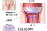 一定要有医生推荐，才能使用这种方法。女性可以自己放入或取出横膈膜，这种像圆屋顶一样的碟状物，可以阻止精子进入子宫颈，在它的底部涂有杀精剂，可以杀死任何接近它的精子。一旦放入后，效果可长达六小时。（图片来源：资料图）