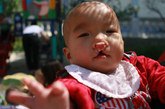 冯瑞安（男），2010年2月8日生，来自呼市福利院，双侧唇腭裂、阴茎畸形右侧隐睾


