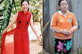 越南一女子过敏后患怪病短时间内衰老50岁：据英国媒体近日报道，一名越南年轻女子因对海鲜极度过敏引发怪病，短短几个月内就从23岁的迷人美女变成73岁的老妇。这名女子名叫阮莳芳（Nguyen Thi Phuong），现年26岁。有专家认为，阮时芳的这种情况属于脂肪代谢障碍，这种病症极为罕见，全球大约只有2000人患有此病。（图片来源：光明网）

