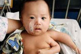 2006年，刘俊杰（音译）出生于中国安徽省。他出生时竟长着三只手臂。医生成功地移除了这个非常罕见、发育健全的第三只手臂，但是他需要长期进行治疗，以保持两个正常手臂的活动自如。第三只手臂没有手掌，而且手腕没有方向。
