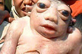 2006年，一个外貌奇特的婴儿出生于尼泊尔多拉克哈地区，他的出生吸引了无数人的旁观和关注。这个婴儿几乎没有脖颈，头部几乎完全陷入上半部身体里，他的眼睛非常大，几乎要从眼眶中爆出，被称为“青蛙儿”。但是，他出生不到半小时就死亡了。