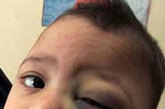 一名患白血病的伊拉克小男孩，据说他是美国贫铀弹污染的受害者。