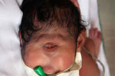 2006年，印度出生一个单只眼睛的女婴，帮助接生的医疗人员认为这个畸形婴儿是由实验抗癌药物造成的，另一份医学诊断报告显示，这可能是由于染色体紊乱导致的。这个女婴被诊断患有一种罕见的染色体紊乱，被称为独眼畸形。她出生时在前额有一个单眼，没有鼻子，她的大脑熔合成一个半球。
