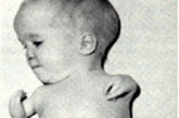 20世纪60年代德国推出一种名叫“反应停”的新药，顾名思义就是用于停止孕妇的早孕反应的药物。然而不幸的是，这种当时颇受孕妇青睐的新药，却导演了一幕人间悲剧──一时间在德国，一种罕见的无肢畸形和短肢畸形婴儿的出生迅速增多。被称为“海豚儿”。

