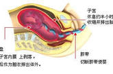 第三产程 (胎盘娩出期〕：指从胎儿娩出到胎盘娩出。 初产妇需十分钟到一个半小时。 胎儿娩出后，仍会有宫缩促使胎盘娩出，只是这时的宫缩相对来说是无疼痛的。随后，医生会替你收拾整洁，如外阴有裂口，则会做局部的缝合。
