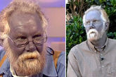 美国男子银中毒变“蓝脸怪” 现年57岁的美国男子保罗14年前患有严重的皮肤病和雀斑，为了治疗严重的面部皮肤病，保罗使用一种含金属银的化合物——“胶态微粒银”来治疗。但是意想不到的是，这种药物不仅没有让他的皮肤好转，反倒适得其反——保罗的脸部颜色居然变成了蓝色，他成了人们议论纷纷的“蓝脸怪”，数月不敢见人。（图片来源：光明网）
