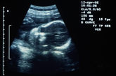 4、子宫口已开全，胎头较低，但是胎儿有明显的缺氧现象，胎儿的心率发生异常变化，或心跳节律不匀，并且羊水混浊或混有胎便。