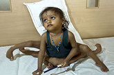 四肢最多的连体双胞胎—蜘蛛女孩

现年2岁的印度女孩拉克什米·塔特玛属于发育不完全的连体双胞胎，也就是说，这对双胞胎中的另外一个孩子只长出了双臂和双腿。拉克什米的肢体分离手术需要大约20万美元费用。手术需要的技术设备也是医学界最先进的。
