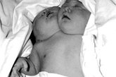 中国首例双头女婴引起轰动

5月5日，四川省遂宁市一农妇剖腹产下一对连体女婴，体重达4050克。两个婴儿有两个脊柱、两根食管，心脏有一个半，其他器官都共用，无法进行分离手术。专家称这通常被称作“双头畸胎”，是两胎连体的一种极端现象。“双头人”中国还没有先例，在全世界也极为罕见。

 

