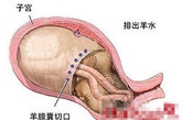 剖腹产手术的位置 剖腹产手术的切口位置在下腹壁下垂的皱褶处，也就是耻骨上3厘米处的腹壁上。（资料图） 