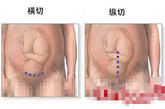 剖腹产手术过程详细图解（资料图）