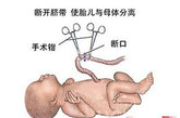剖腹产手术过程详细图解（资料图）
