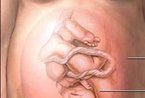 剖腹产手术过程详细图解(组图)