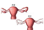 图解女性输卵管结扎手术(图)