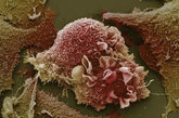 肺癌细胞 这张异常的肺癌细胞图。（文/凤凰网健康综合，图/资料图） 


