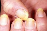 指甲厚黄：加5岁。研究显示，未经修饰的指甲显得人更老，因为指甲油能掩盖与疾病和衰老有关的黄指甲。专家表示，维生素及湿度缺乏会导致指甲未老先衰。垃圾食品是破坏指甲的罪魁之一，应当杜绝。
