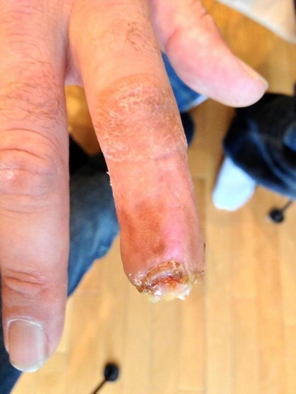 保罗·哈尔彭的手指被马咬掉1/3.