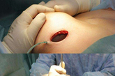 实拍隆胸假体植入过程图片