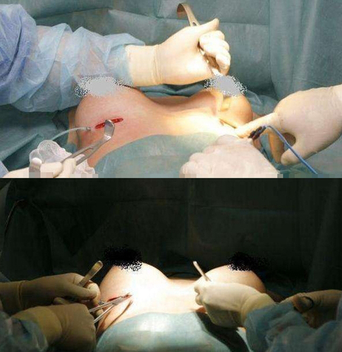 震撼实拍国外美女隆胸手术全程(图)