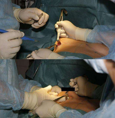 隆胸手术全程记录图片